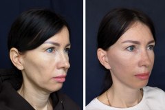 Операции на лице